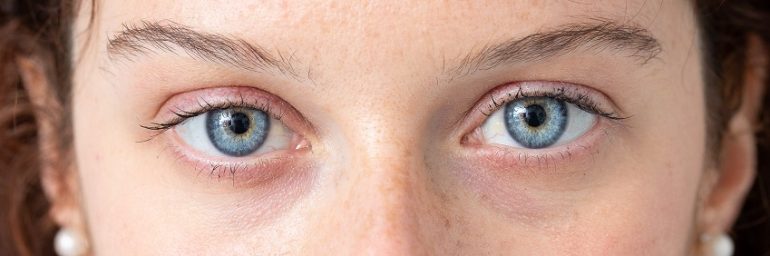 Augenringe entfernen – die Unterspritzung der Tränenrinne